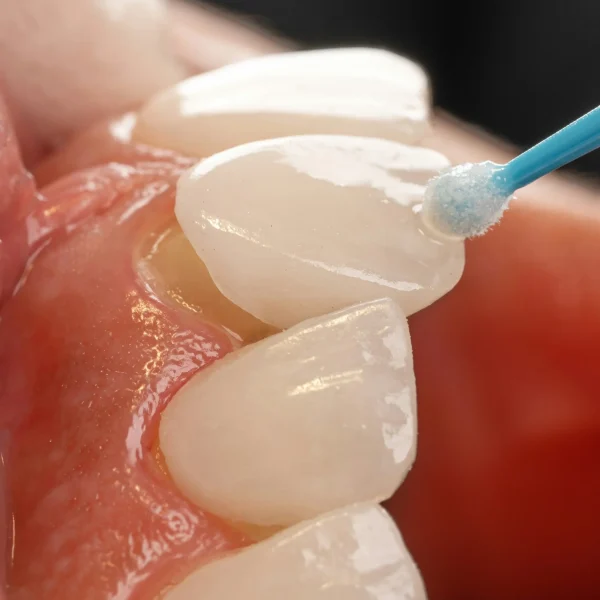 Carillas foto 2 (rotar la foto y ponerla en horizontal)