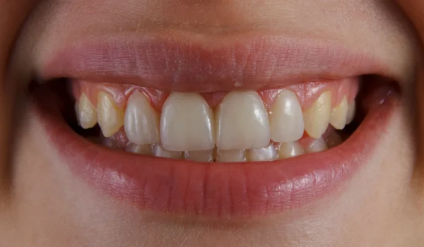Implantes dentales Foto 2