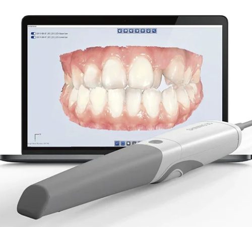 escaner-dental-intraoral-ejemplo